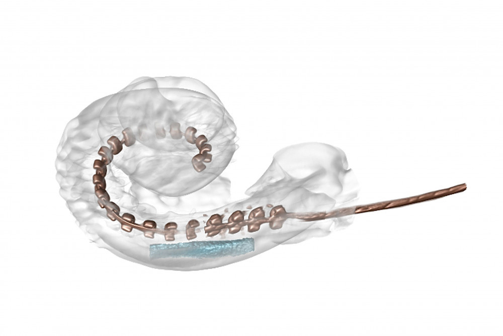 3D-Darstellung des Wirkstoffdepots (blau) im Ohr neben einer Elektrode eines Cochlea-Implantats