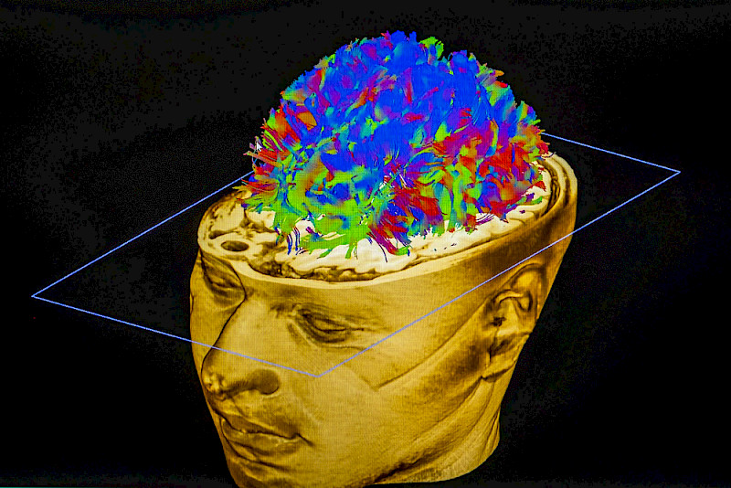 Mit Diffusions-Tensor-Bildgebung werden die wichtigsten Faserverbindungen im Gehirn dargestellt.
